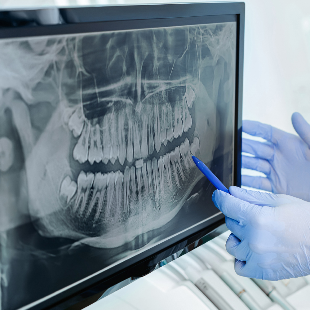 20-guide-implant-dentaire