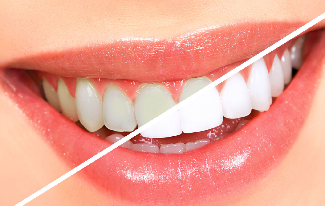 clareamento-dental-04