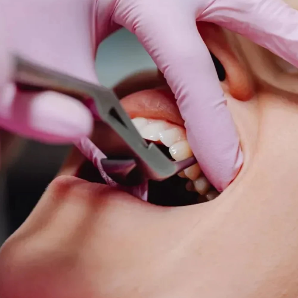 ortodonti-tedavisinde-dis-cekilir-mi